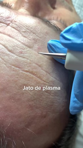 Tratamentos com Jato de Plasma por Dra. Amanda Albuquerque