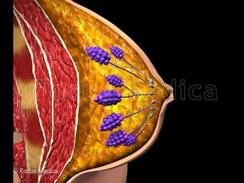 Breast Cysts - Animated Atlas of Breast and Gastric Cancer