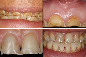 Shocking photos reveal how booze destroys your teeth - as dentist warns of worst drinks