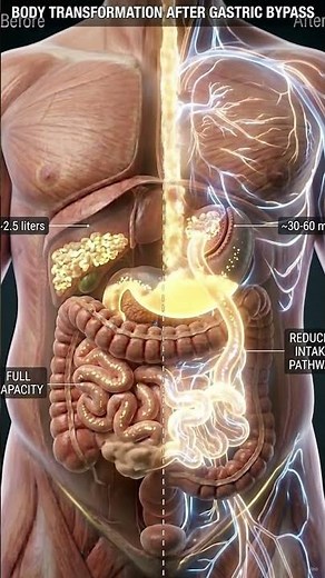 what actually happens when gastric bypass is done #medicalanimation