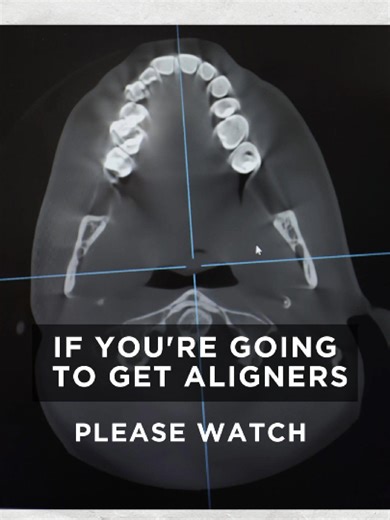 Jaw Evaluation for Aligner Therapy: A Must-Do