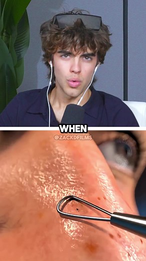 How to Properly Get Rid of Blackheads with Acid Dissolvers