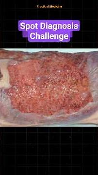 Spot Diagnosis Challenge 17 #OSCEs #spotdiagnosis #ulcer #dermatology