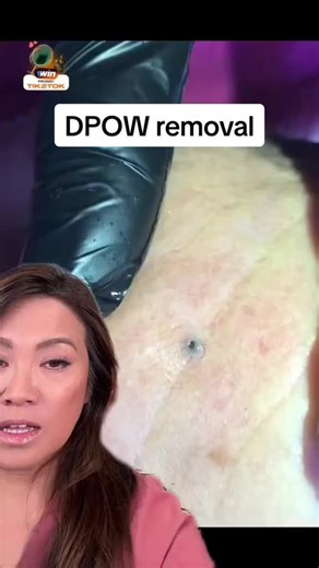 Gotta love a good Dilated Pore of Winer (DPOW) 😍 Washing your face may not be enough to prevent this from happening 😬 Salicylic acid is able to settle deep within pores to clear them out from any excess oil, dirt and debris thats trapped in there. If you have something like this that you need to extract, we love to recommend retinol to help soften the area beforehand (so you can keep the pen on your desk and off you face 😉) Shop both of these (and a @Sandra Lee, MD comedone extractor similar 