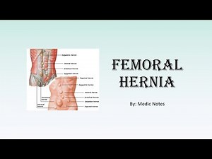 Femoral hernia - anatomy, clinical features, differential diagnosis, investigation, management
