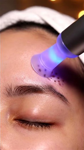 ASMR Dermatology: Left Forehead Blackhead Suction #asmr #shortsfeed #dermatology
