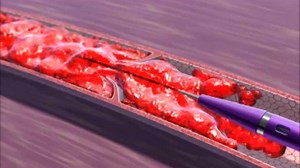 AngioJet模拟视频版