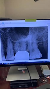 RCT through a crown. #dentistry #rootcanalretreatment #dentalschool #dentists #RootCanalTherapy | Advanced Micro-Endodontics