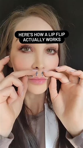 The Lip Flip Explained ⤵️ ✔️A Botox Lip Flip relaxes the muscle around your upper lip ✔️When the muscle is relaxed, it can't contract fully (tighten or shrink down) ✔️As a result, your lip turns upward and outward And looks fuller 🙌🏻 ⚠️But Botox here 💋 doesn't come without a small chance of side effects... They're usually mild & short-lived Higher dose = higher chance of side effects... ...like trouble drinking from a straw #lipflip #lipflipbotox #lipinjections #botoxinjections #lipaugmentati