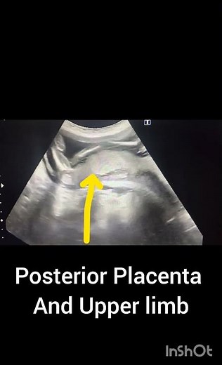 Obstetric Ultrasound showing posterior Placenta! Placenta Position Ultrasound!#ultrasoundmadeeasy86
