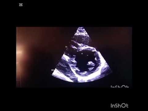 LV Mass Explained in 5 Minutes | Feigenbaum Formula Made Simple