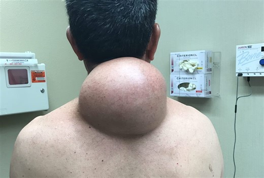 Who You Calling Fatty? Here's What You Need to Know About Lipomas!