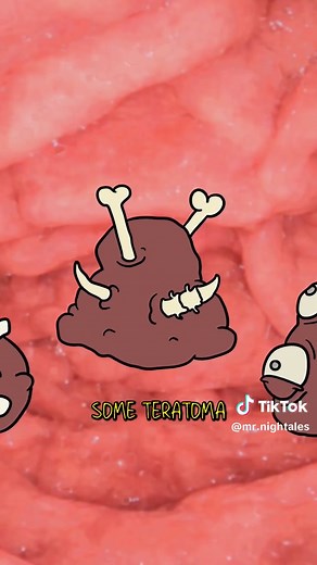 What is a Teratoma? #learnontiktok | teratorma