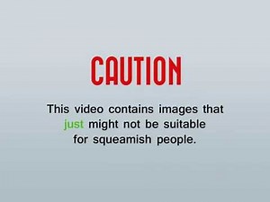 Time-Lapse Video of a Sutured Wound Healing Over a Period of 56 Days