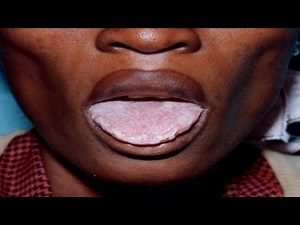 LE SIDA/VIH - CONNAÎTRE LES SYMPTÔMES AVANT QU'IL NE SOIT TROP TARD - C'EST QUOI LE SIDA - VIH