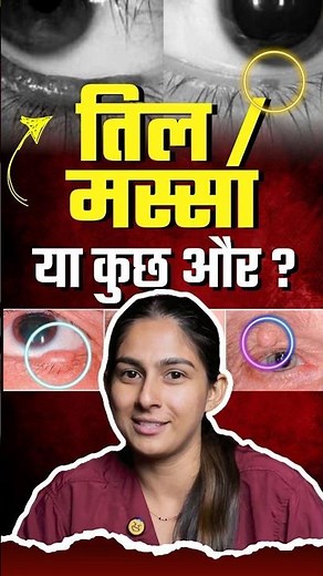 Don’t Ignore These Eyelid Moles | Early Signs of Basal Cell Carcinoma #facts #eyecareexcellence