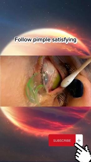 Big pimple satisfying removal #popping #pimple #extractions #relax #satisfyingvideo
