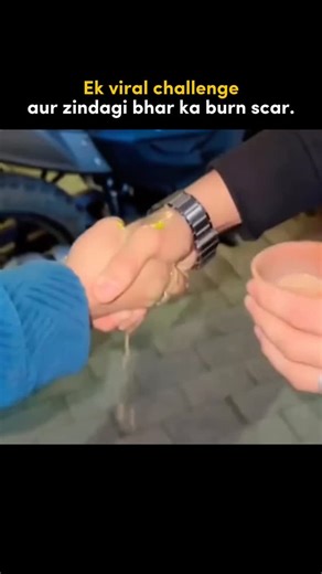 Mamta Pathology | MPUC Diagnostics on Instagram: "The “hot tea challenge” may look harmless, but it can cause deep burn injuries in seconds. Hot liquids penetrate the skin quickly and may leave permanent scars. Doctors strongly advise against trying or promoting such trends. If a burn happens, use running water immediately and seek medical care. Reels fade. Scars don’t. Please share this. #burnawareness #viralchallenge #safetyfirst #burninjury #medicalwarning hot tea challenge burn scar viral ch