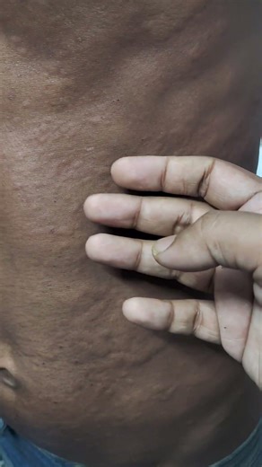 Urticarial Rash