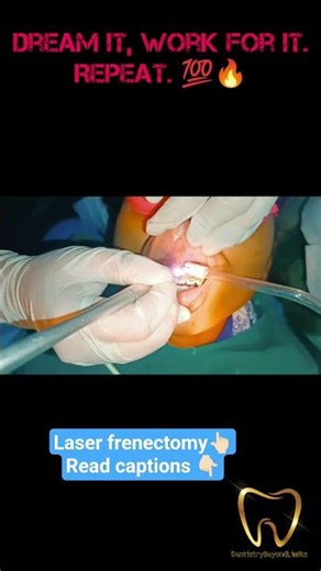 Laser Frenectomy| Dental surgery| Laser #lasercutting #laser #frenectomy #shorts #neet #inspireneet