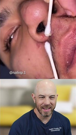 Pimple Extraction with Q-Tips: Why You Should Poke First