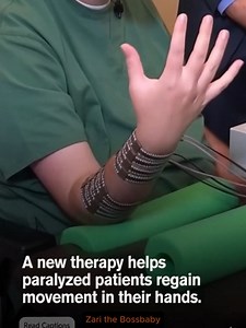 At the Battelle Memorial Institute in Ohio, doctors and neuroscientists have developed a breakthrough therapy that helps paralyzed patients regain hand movement. The treatment combines targeted nerve stimulation with intensive physical training to reconnect damaged brain pathways once thought to be beyond repair. In trials, participants who had been paralyzed for years were able to perform small but meaningful actions, such as gripping and holding objects. Led by researcher Dr. Chad Bouton, the