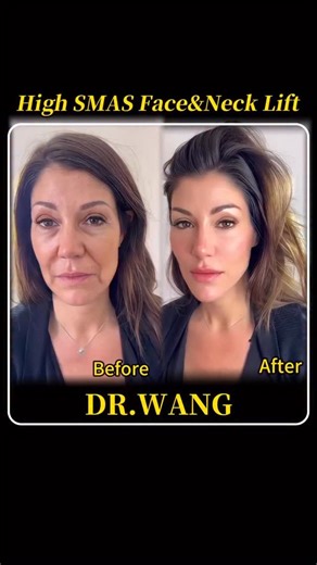 上海整形🏥王进刚 on Instagram: "The Best Results Go Unnoticed No sharp angles. No pulled skin. Just a face that looks rested — the way it should have aged. ZenLift™ corrects structure, not identity. #ZenLift #NaturalFacelift #NoMaskFace #DeepStructureLift #DrWang"