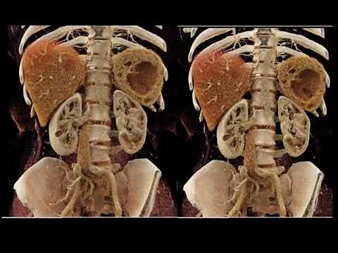 CT Evaluation of the Spleen: Challenges in Diagnosis Part 2