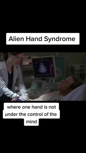 Alien Hand syndrome #medical #medicine #medicineexplained #education #learnontiktok #edutok