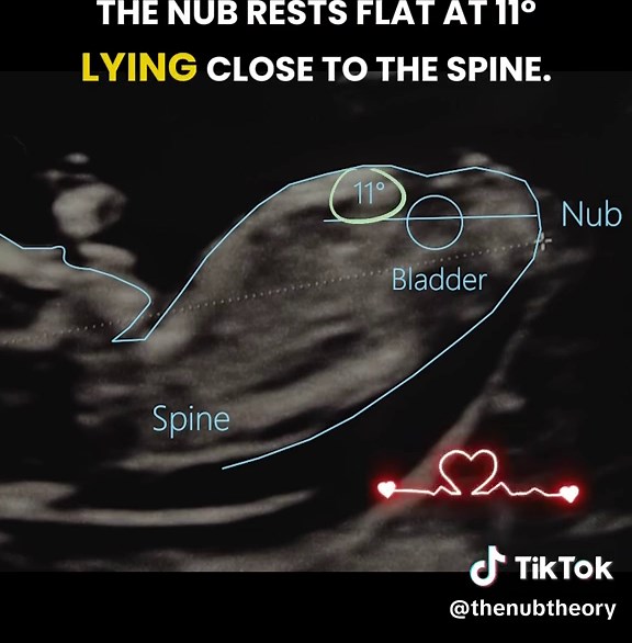 He or She? The link to the gender prediction app is in my profile 🩷💙 #nubtheory #genderreveal #genderscan #nubxapp