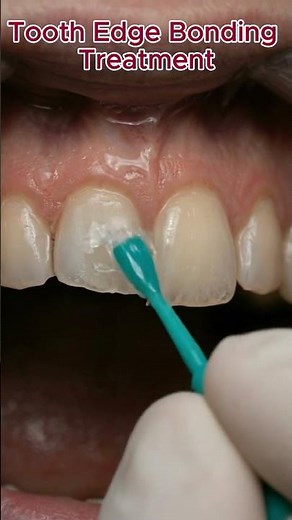 Tooth Edge Bonding Treatment 🦷