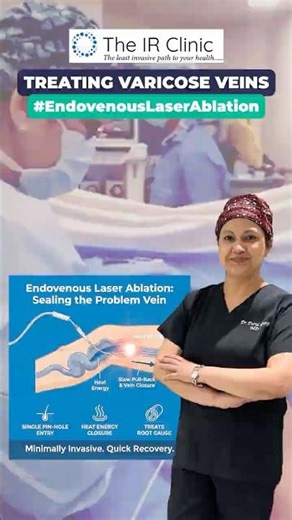 Endovenous Laser Ablation for Varicose Veins Treatment in Delhi | by Dr. Parul Garg at The IR Clinic