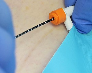 Radiofrequency Ablation - Varicose Vein Treatment