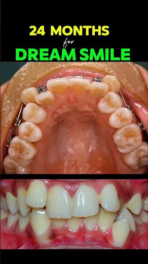 This is how braces fix CRAZY TEETH #braces torthodontist #dentist #teeth