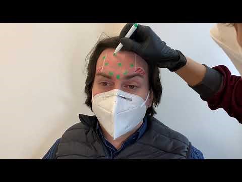 Marcação de Pontos Aplicação de Toxina Botulínica - Clinic Cursos