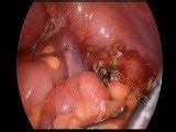Apendicectomia • Vídeo • MEDtube.es