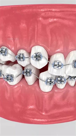 2K views | Abnormal Teeth Position and Its Correction with Braces #teethalignment #bracestreatment #orthodontics #DentalCare #toothalignment | Health Doctors | Facebook
