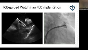 ICE Guided Watchman FLX Implantation Workflow. Pre-Procedural CT, Intra-Procedural ICE from the LA, Follow-up CT