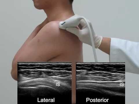 US-guided exam and injection of the shoulder _0516 Final.flv
