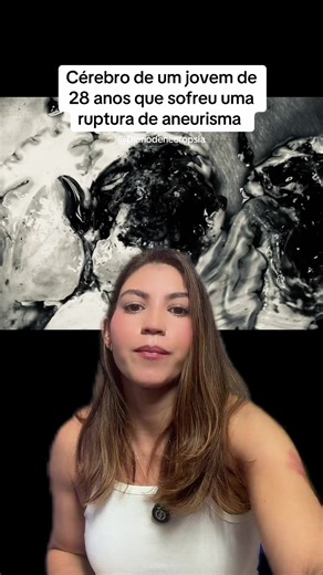 Aneurisma Cerebral: O Caso de um Jovem de 28 Anos