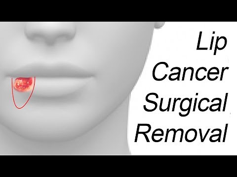 Lip Cancer Wedge Excision with Primary Closure