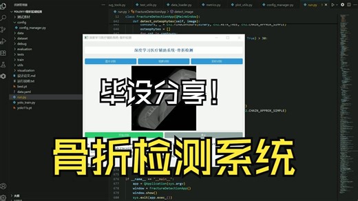 毕业设计 深度学习骨折检测医疗辅助系统