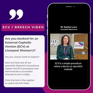 Liverpool Women's External Cephalic Version (ECV) Are you booked for a ECV at Liverpool Women's? Are you unsure what to expect? Here we have two of our specialist Obstetric Consultants explain the ECV procedure and demonstrate a successful attempt to turn a baby. Click the link to watch the full video https://orlo.uk/leB2g #babybreech #ECV #externalcephalicversion #liverpoolwomens #pregnancy #antenatal #care #procedure | Liverpool Women's University Hospital | Facebook
