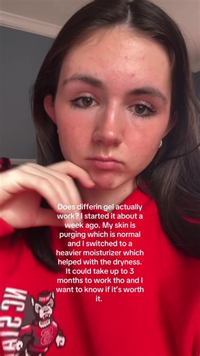 Effective Sunscreen Recommendations for Acne-Prone Skin