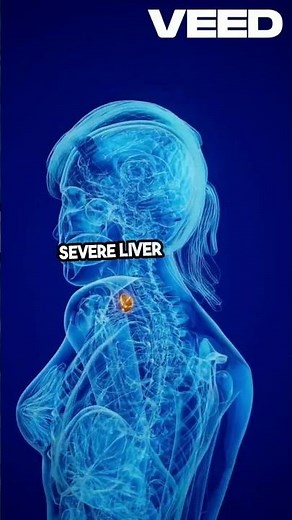 Elevated Ammonia Signs of Liver Failure