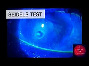 Simply Eye - 👁️ Seidels Test🧿