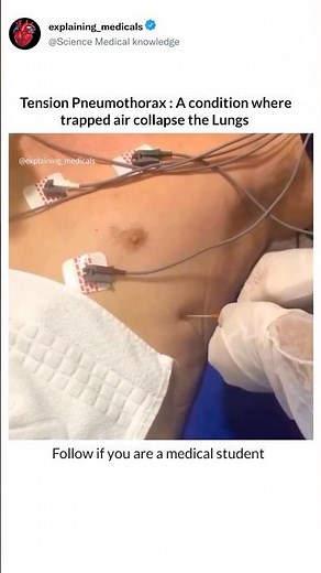 Tension Pneumothorax: A condition where trapped air collapse the Lungs 🫁 #pneumothorax
