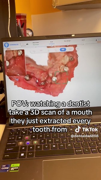 This is how our office does 3D dentistry! Using cutting edge 3D cameras allows our office to create the highest quality and most precise implants, surgical guides and smiles! This scan happened right after we extracted 16 teeth from our patients lower gums. The surgery happened so recently that you can see the stitches we just used to close the incisions. If you’ve been curious about 3D dentistry, experiencing problems with your teeth or just need a regular check up then give our office a call t