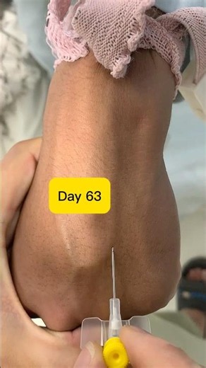 How to Insert a 24G Yellow IV Cannula on the Hand Perfectly! | Day 63 Clinical Skills#shorts #safi