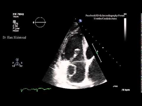 Right Atrial Thrombus